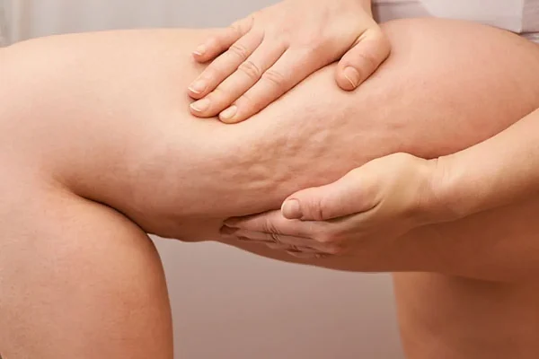 CinfaSalud-celulitis-600-1200x800
